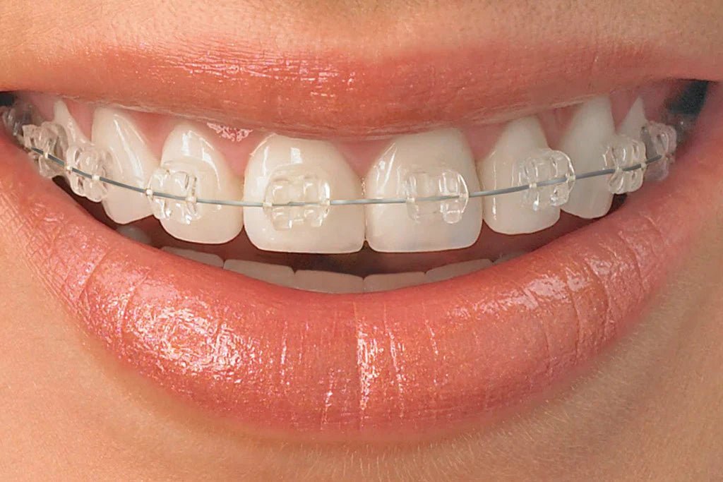 Can You Vape with Braces?