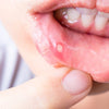 Does vaping cause mouth ulcers?; The Surprising Connection You Need to Know - Mister Vape