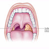 Does Vaping cause tonsillitis? Vaping and Tonsillitis - Mister Vape