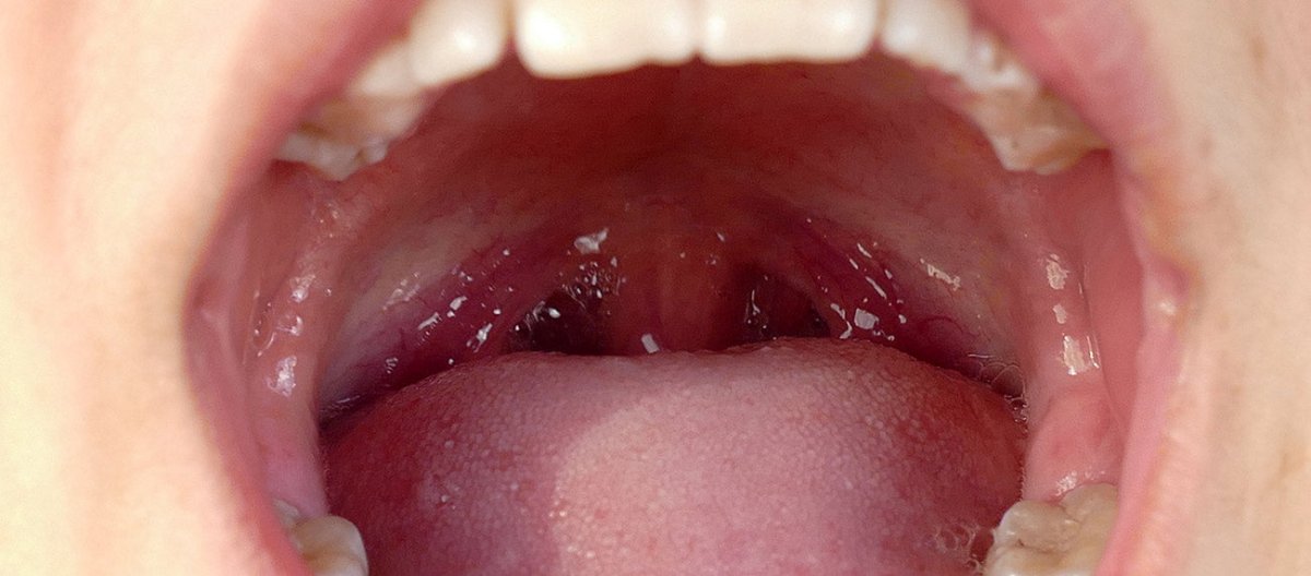 Can Vaping Cause Tonsil Stones?