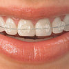Can You Vape with Braces? - Mister Vape