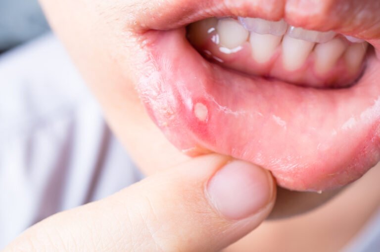 Does vaping cause mouth ulcers?; The Surprising Connection You Need to Know