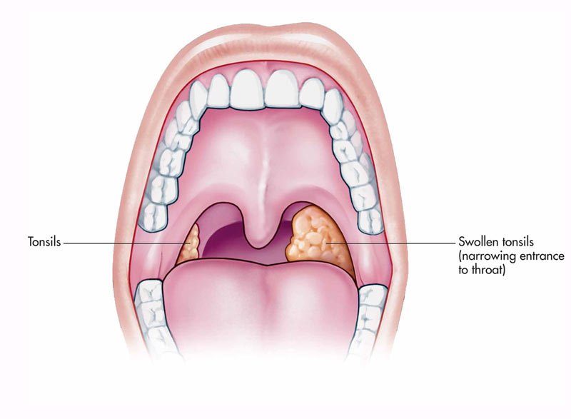 Does Vaping cause tonsillitis? Vaping and Tonsillitis